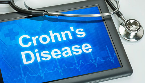 What is the action of stem cells in treating crohn's disease biologics therapy Crohn’s Disease